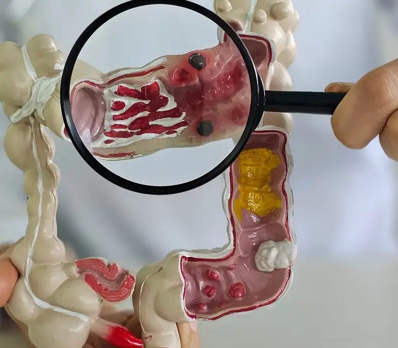 Em 13 anos, doença inflamatória intestinal cresce 5 vezes no Brasil
