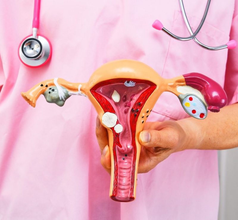 Planos de saúde passam a cobrir DIU hormonal para pessoas com endometriose