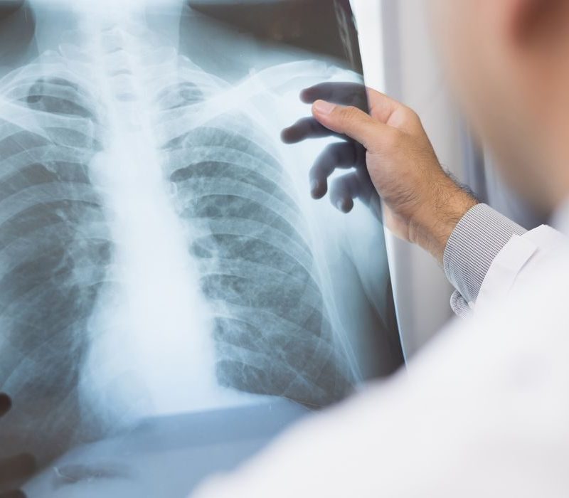 Anvisa aprova novo medicamento para câncer de pulmão avançado