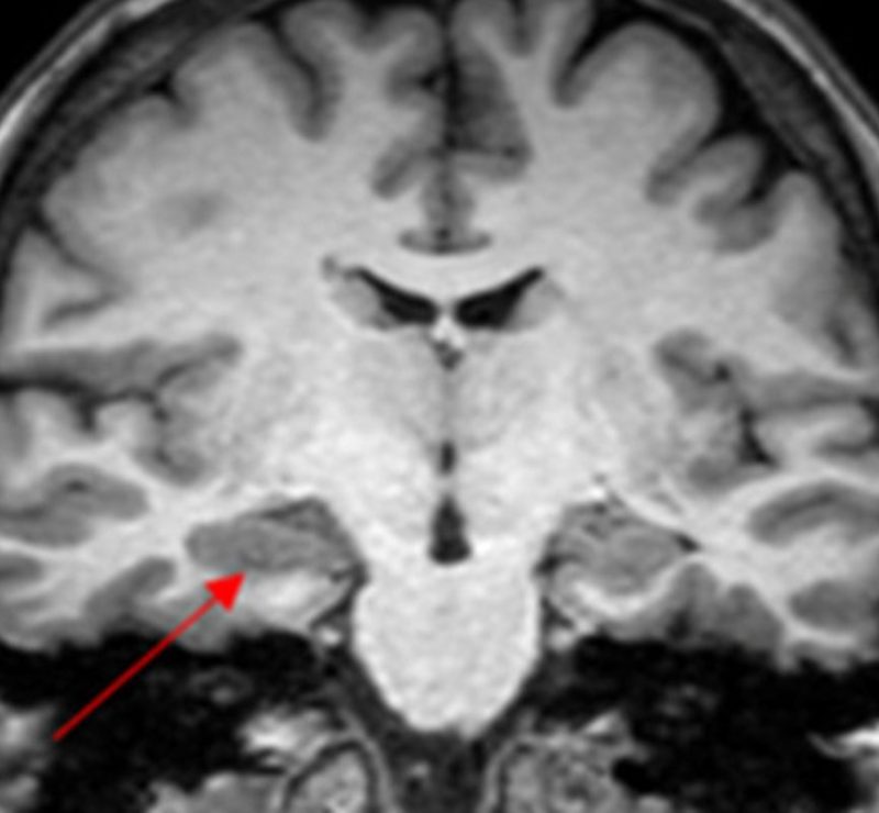 Caso de convulsão na menstruação levanta suspeita de endometriose cerebral