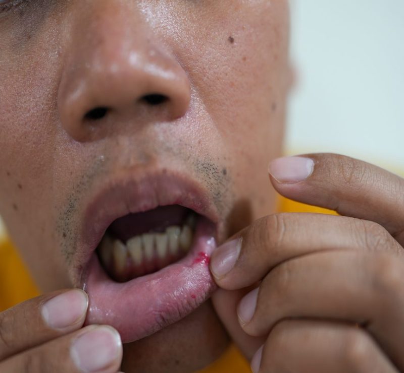 Cuidado bucal e dieta ajudam a aliviar inflamações da quimioterapia