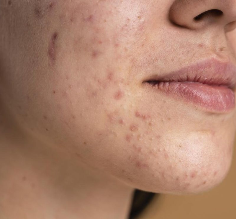 Espremer espinhas profundas aumenta o risco de infecção e cicatrizes