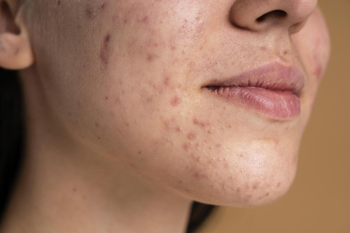 Espremer espinhas profundas aumenta o risco de infecção e cicatrizes