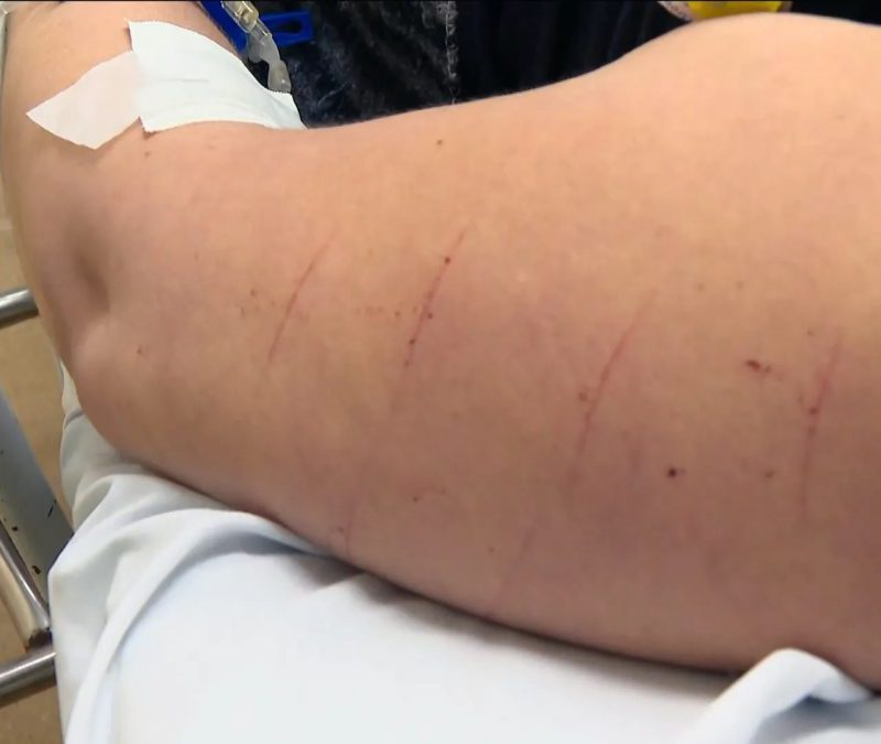Mulher relata ter sido atacada com tesoura durante assalto em São Gonçalo; um dos golpes foi na barriga