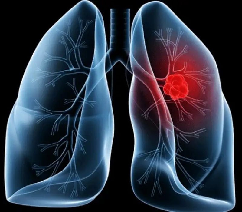 Saiba o que é adenocarcinoma pulmonar, câncer que atinge o papa