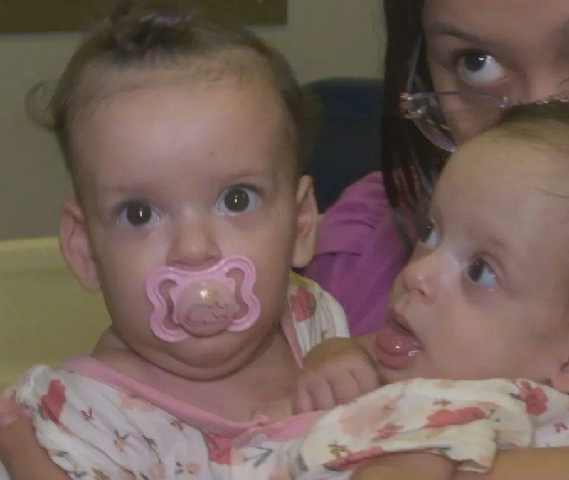 Siamesas de São Paulo passam por nova cirurgia em Goiás durante preparação para serem separadas