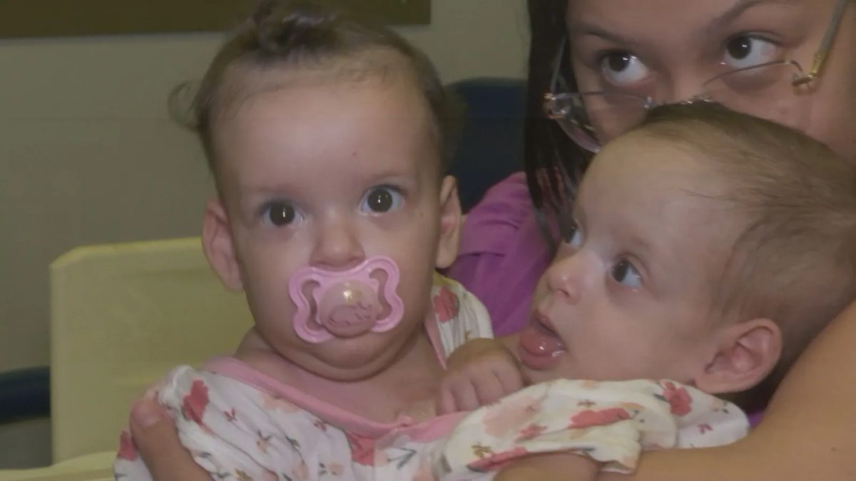 Siamesas de São Paulo passam por nova cirurgia em Goiás durante preparação para serem separadas